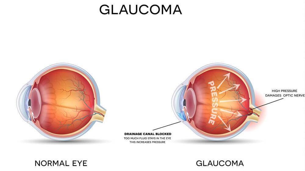 Glaucoma Diagram